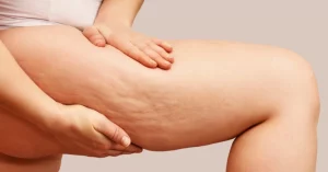Mesotherapy For Cellulite