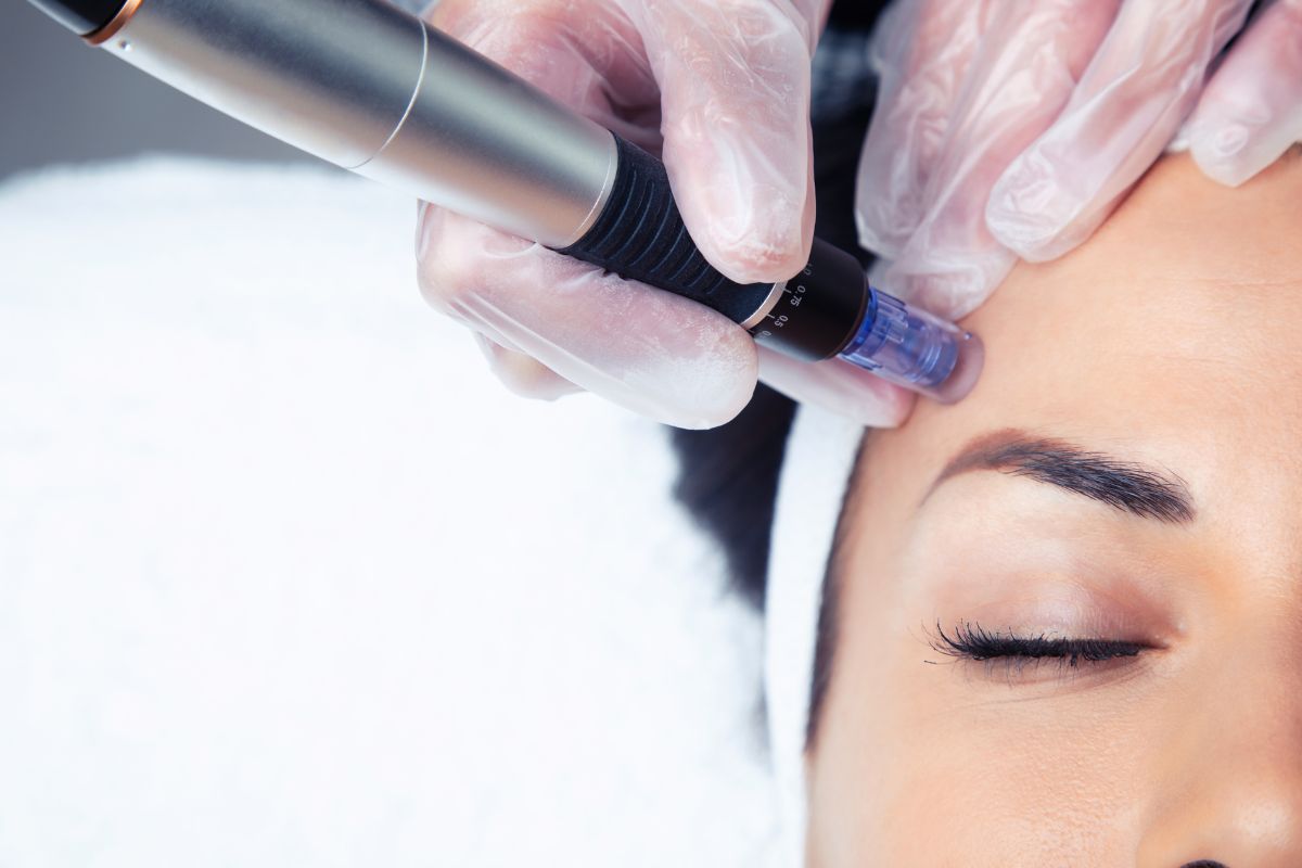 The Science Behind SkinPen Microneedling in Newcastle