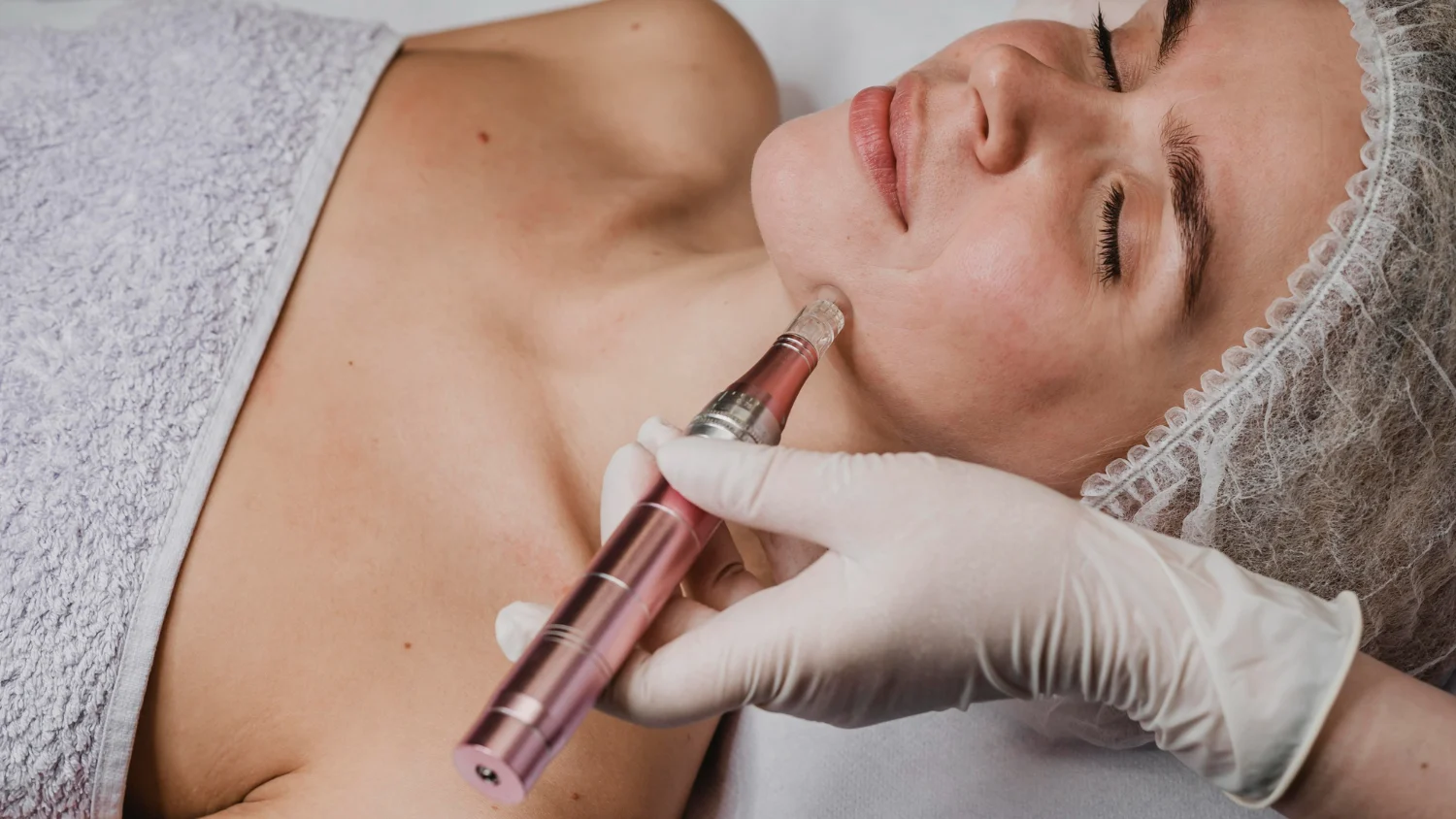 Reduce Scarring, Fine Lines & Large Pores With SkinPen In Newcastle
