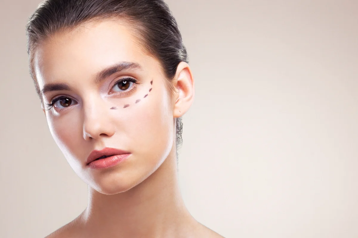 Tear Trough Filler In Newcastle & How It Treats Under Eye Hollows